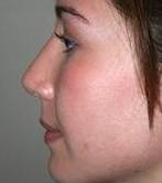 after rhinoplasty female patient left side view case 1946
