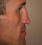 Before Rhinoplasty Male Patient Side Angle View Case 1956