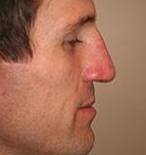 After Rhinoplasty Male Patient Side Angle View Case 1956