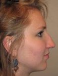 Before Rhinoplasty Female Patient Side Angle View Case 1965