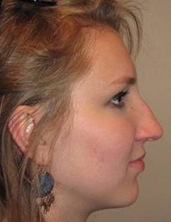 Before Rhinoplasty Female Patient Side Angle View Case 1965