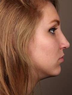 After Rhinoplasty Female Patient Side Angle View Case 1965