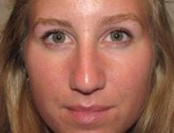 Before Rhinoplasty Female Patient Front Angle View Case 1977