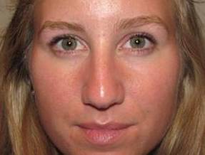 Before Rhinoplasty Female Patient Front Angle View Case 1977