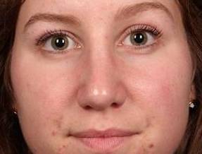 After Rhinoplasty Female Patient Front Angle View Case 1977