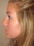 Before Rhinoplasty Female Patient Side Angle View Case 1977