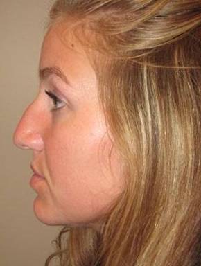 Before Rhinoplasty Female Patient Side Angle View Case 1977