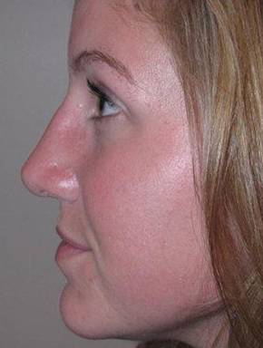 After Rhinoplasty Female Patient Side Angle View Case 1977