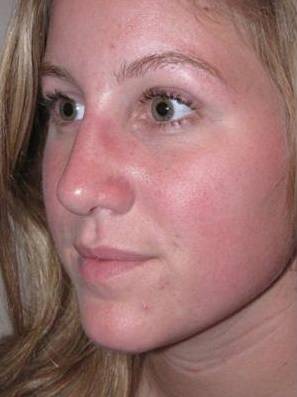 After Rhinoplasty Female Patient Diagonal Angle View Case 1977