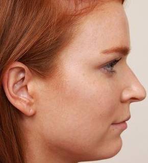 Before Rhinoplasty Female Patient Side Angle View Case 1984