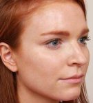 Before Rhinoplasty Female Patient Diagonal Angle View Case 1984