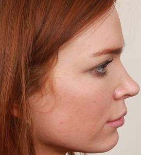 After Rhinoplasty Female Patient Side Angle View Case 1984