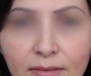 Before Rhinoplasty Female Patient Front Angle View Case 2325