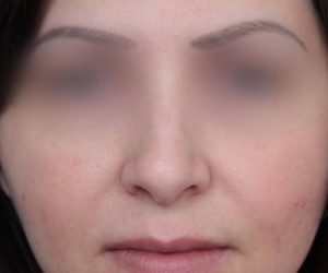 Before Rhinoplasty Female Patient Front Angle View Case 2325