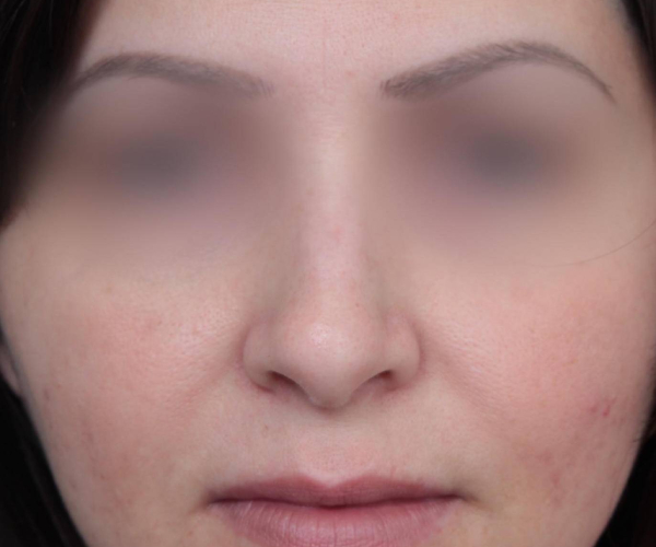 Before Rhinoplasty Female Patient Front Angle View Case 2325