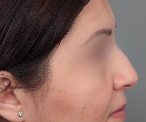 Before Rhinoplasty Female Patient Side Angle View Case 2325