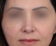After Rhinoplasty Female Patient Front Angle View Case 2325
