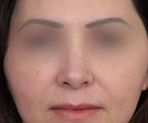 After Rhinoplasty Female Patient Front Angle View Case 2325