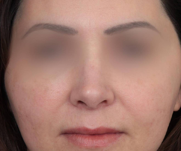 After Rhinoplasty Female Patient Front Angle View Case 2325