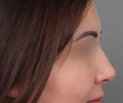 After Rhinoplasty Female Patient Side Angle View Case 2325