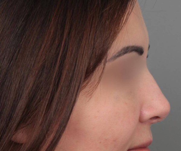 After Rhinoplasty Female Patient Side Angle View Case 2325