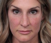 Before Rhinoplasty Female Patient Front Angle View Case 2333
