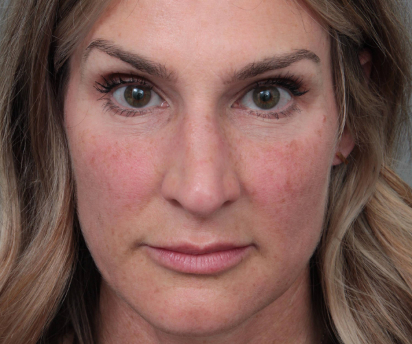 Before Rhinoplasty Female Patient Front Angle View Case 2333