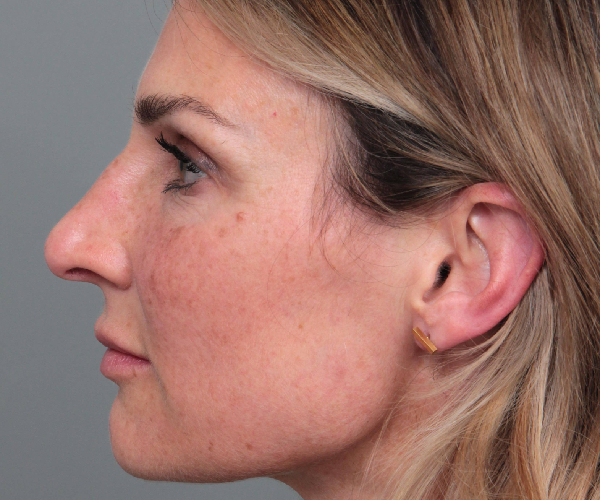 Before Rhinoplasty Female Patient Side Angle View Case 2333