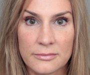 After Rhinoplasty Female Patient Front Angle View Case 2333