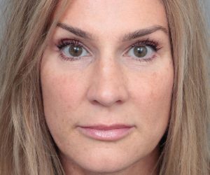 After Rhinoplasty Female Patient Front Angle View Case 2333