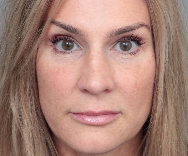 After Rhinoplasty Female Patient Front Angle View Case 2333