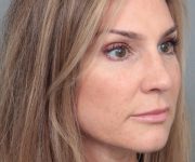 After Rhinoplasty Female Patient Diagonal Angle View Case 2333