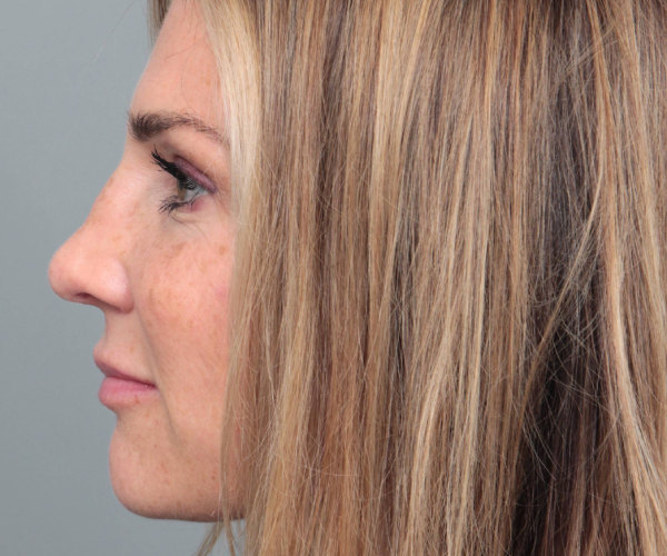 After Rhinoplasty Female Patient Side Angle View Case 2333