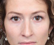 Before Rhinoplasty Female Patient Front Angle View Case 2342