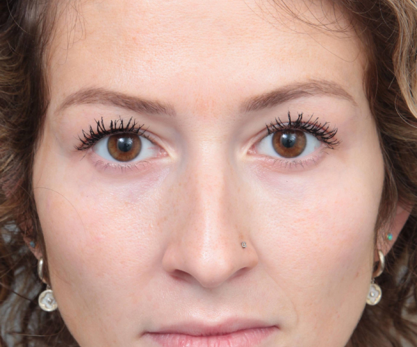 Before Rhinoplasty Female Patient Front Angle View Case 2342