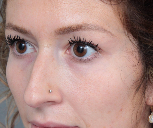 Before Rhinoplasty Female Patient Diagonal Angle View Case 2342