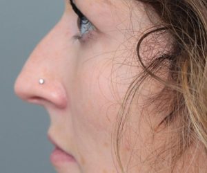Before Rhinoplasty Female Patient Side Angle View Case 2342