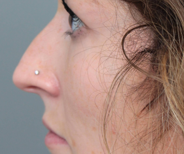 Before Rhinoplasty Female Patient Side Angle View Case 2342