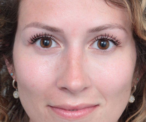 After Rhinoplasty Female Patient Front Angle View Case 2342