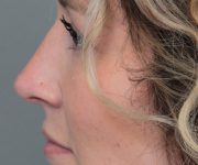After Rhinoplasty Female Patient Side Angle View Case 2342