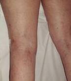 after spider vein removal back legs view female patient case 3023