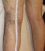 before spider vein removal back legs view female patient case 3023
