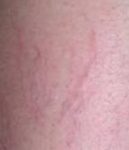 after spider vein removal closeup view female patient case 3026