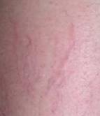 after spider vein removal closeup view female patient case 3026