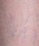 before spider vein removal closeup view female patient case 3026
