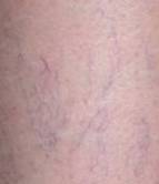 before spider vein removal closeup view female patient case 3026