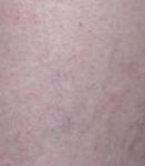after spider vein removal closeup view female patient case 3026
