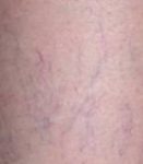 before spider vein removal closeup view female patient case 3026