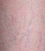 before spider vein removal closeup view female patient case 3026