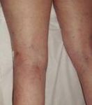 after spider vein removal back legs view female patient case 3026